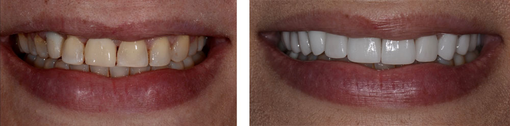 Smile design with multiple upper implants